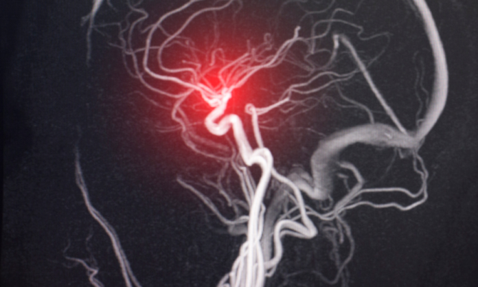 brain aneurysm symptoms